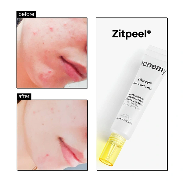 Кислотний незмивний пілінг для шкіри схильної до висипань